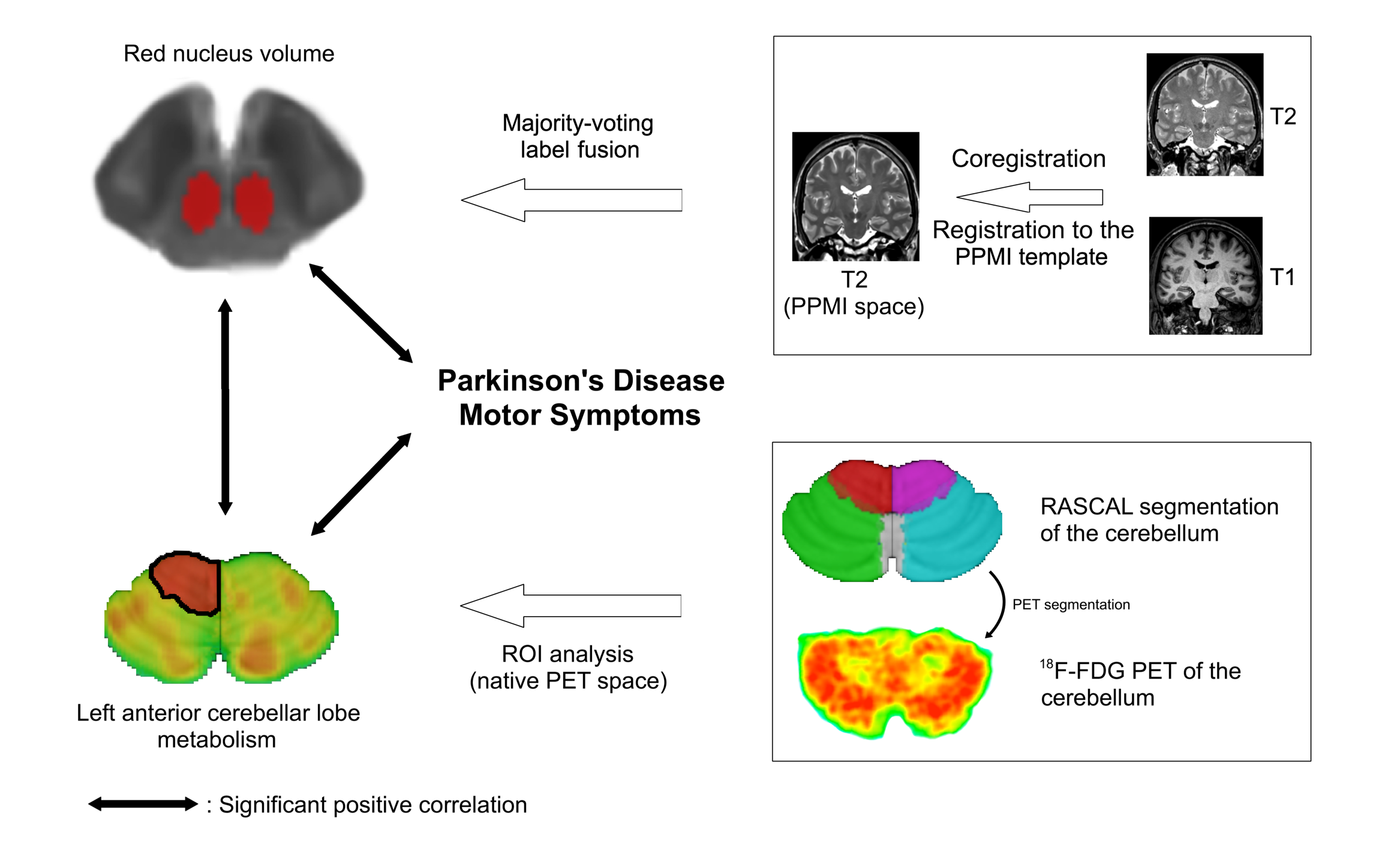 parkinson-s-disease-motor-symptoms-are-linked-to-red-nucleus-volume-and